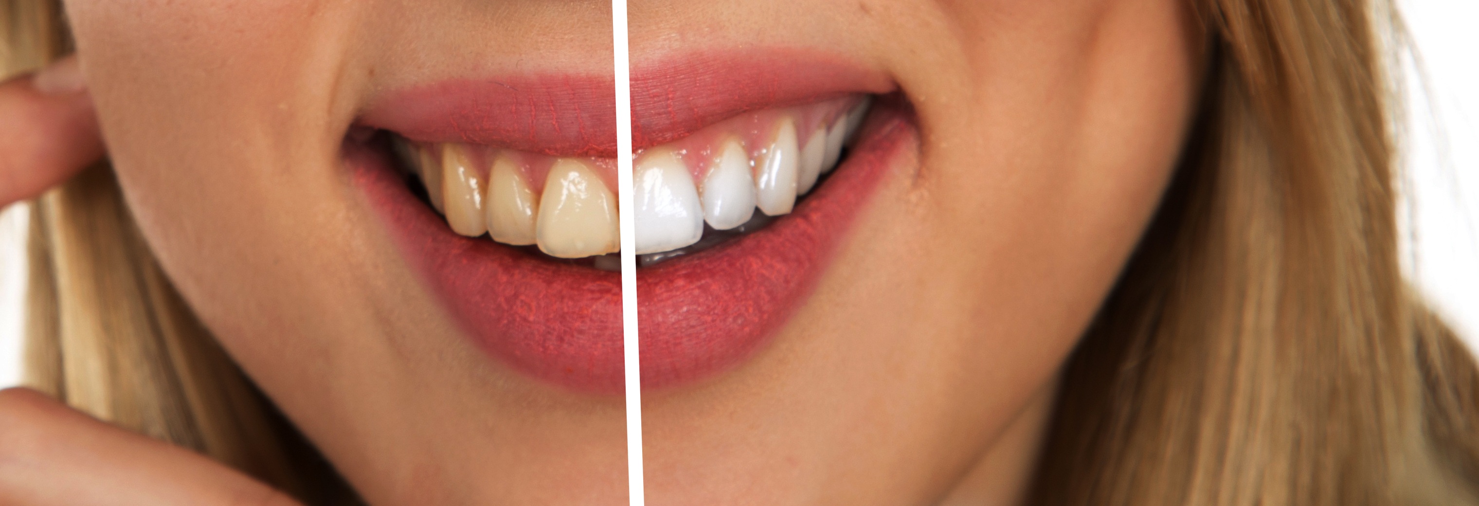Seeking Safe and Stable At-Home Teeth Whitening Technologies with Low or Zero Peroxide Release
