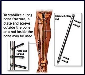 Open Reduction Internal Bone Fixation