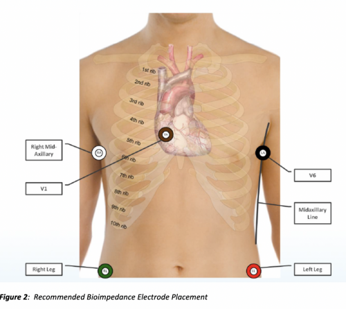 Shimmer3 Bioimpedance Monitor - Monitoring HR, respiration rate and depth, and the increase in fluid in the lungs to triage and remotely monitor Covid-19 patients